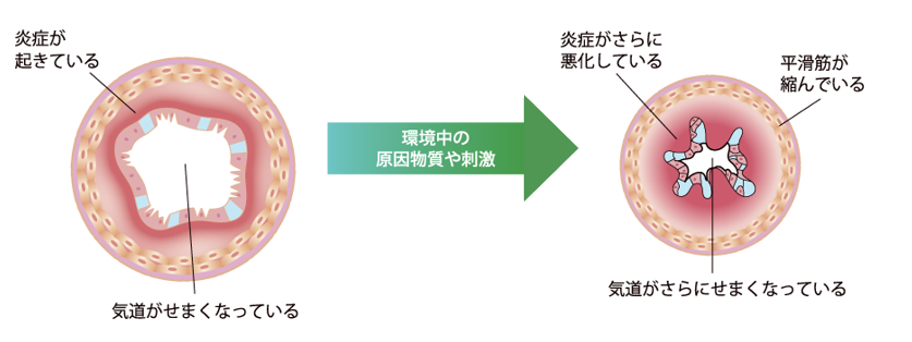 気管支ぜんそく | かなづクリニック